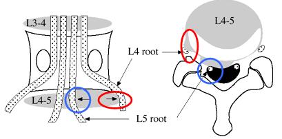Lumbar Disc Herniation - Spine - Orthobullets